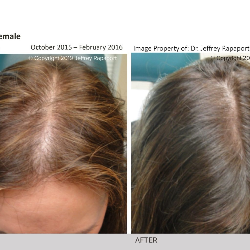 Can Dimethicone Cause Hair Loss? + What Are The Safer Alternatives