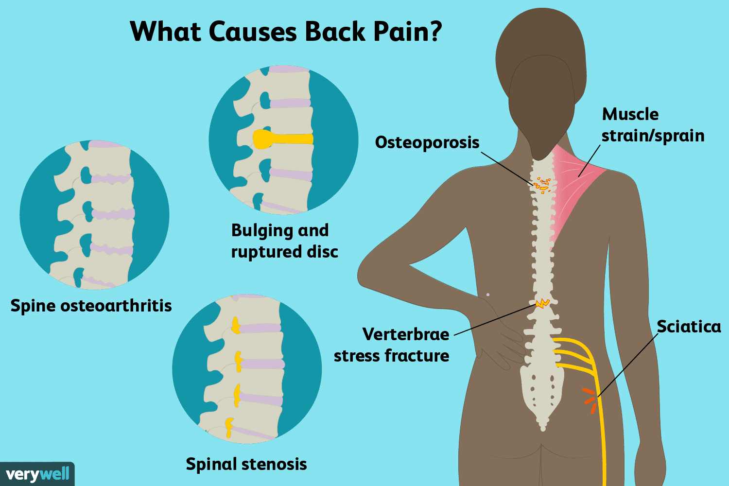 Upper Back Pain - Absolute Health Center