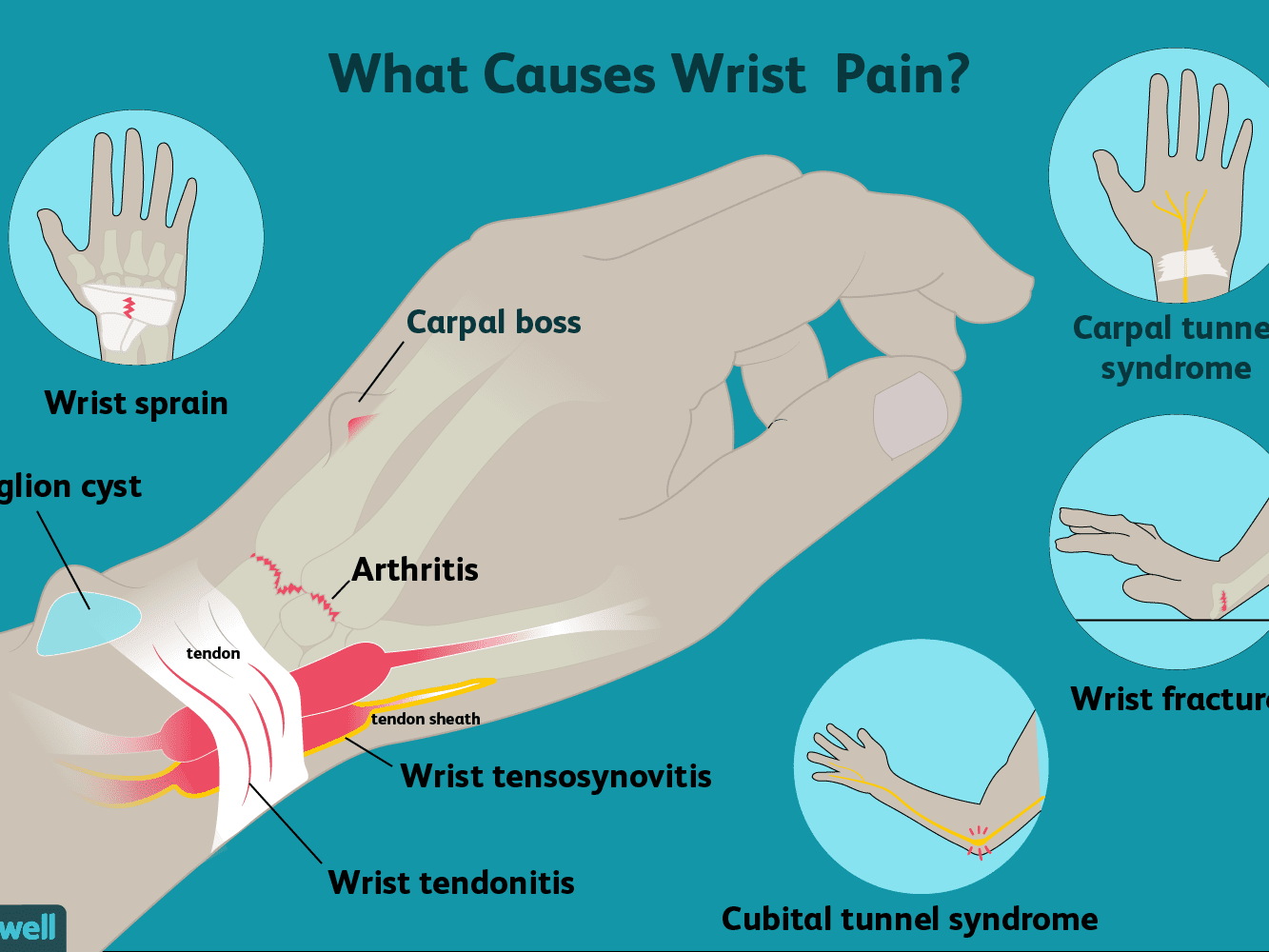 wristpainfinal-01-5c45e56c4cedfd0001871f4e